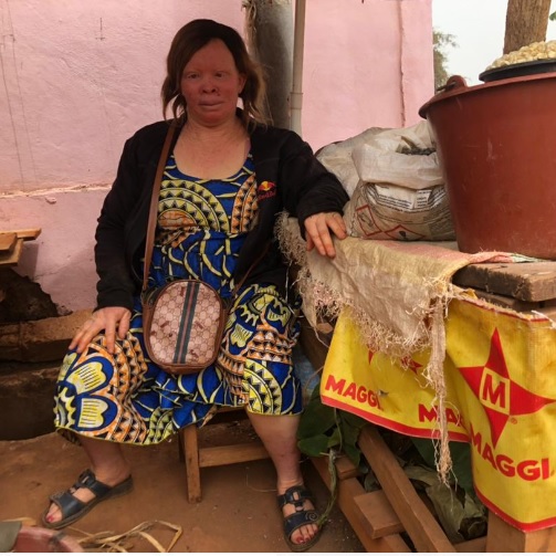 CAMEROUN :: Bafoussam, Inscriptions,listes électorales: Les femmes atteintes d’albinisme ne se mobilisent pas :: CAMEROON Bafoussam, Inscriptions,listes électorales: Les femmes atteintes d’albinisme ne se mobilisent pas